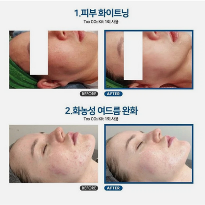 Celldich TOX CO₂ KIT (6 Treatment Sessions)